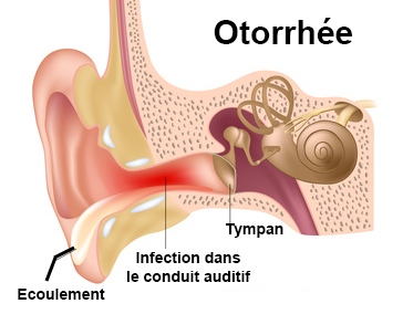 schéma otite externe